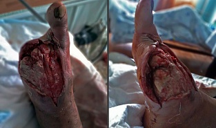 Диабетическая стопа